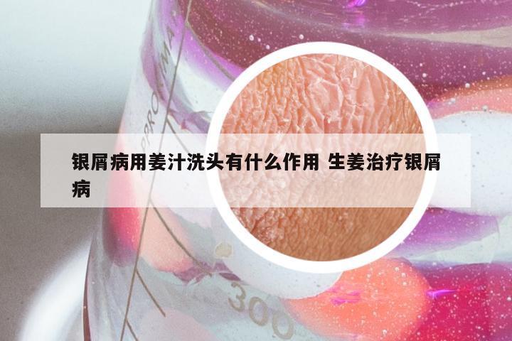 银屑病用姜汁洗头有什么作用 生姜治疗银屑病