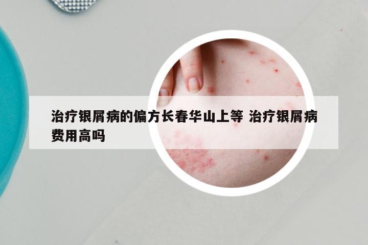 治疗银屑病的偏方长春华山上等 治疗银屑病费用高吗
