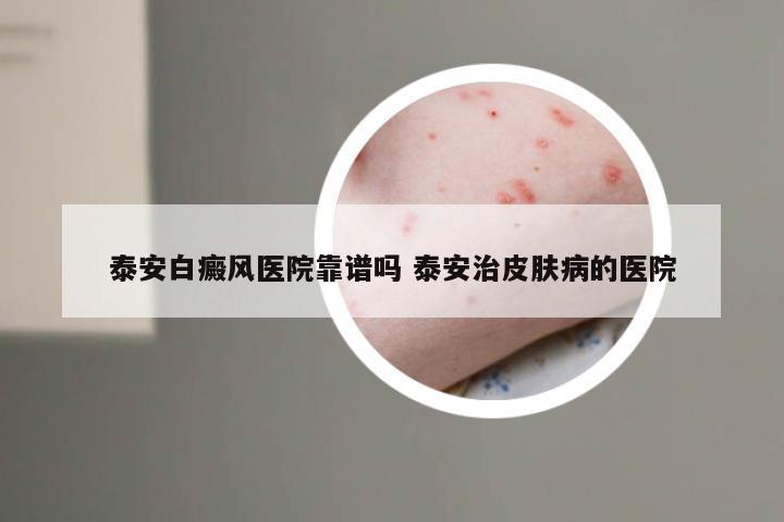 泰安白癜风医院靠谱吗 泰安治皮肤病的医院