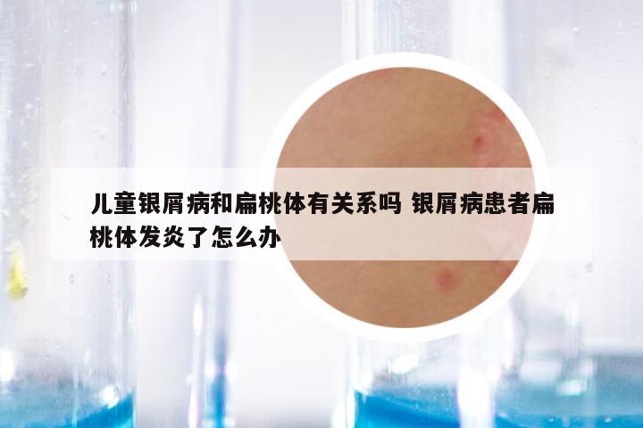儿童银屑病和扁桃体有关系吗 银屑病患者扁桃体发炎了怎么办