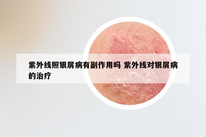 紫外线照银屑病有副作用吗 紫外线对银屑病的治疗