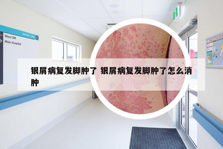 银屑病复发脚肿了 银屑病复发脚肿了怎么消肿