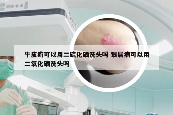 牛皮癣可以用二硫化硒洗头吗 银屑病可以用二氧化硒洗头吗