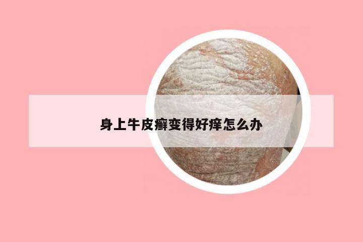 身上牛皮癣变得好痒怎么办