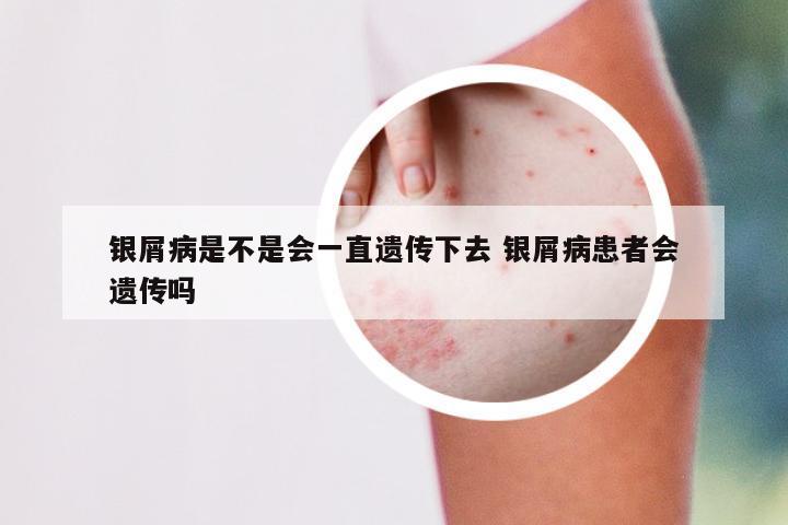 银屑病是不是会一直遗传下去 银屑病患者会遗传吗