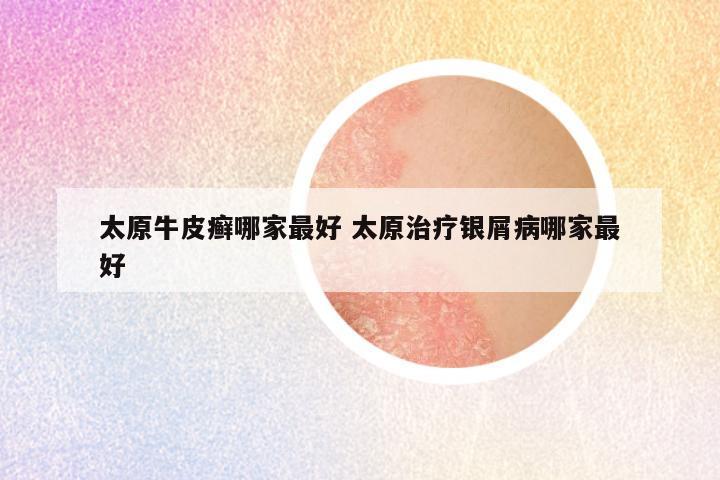 太原牛皮癣哪家最好 太原治疗银屑病哪家最好