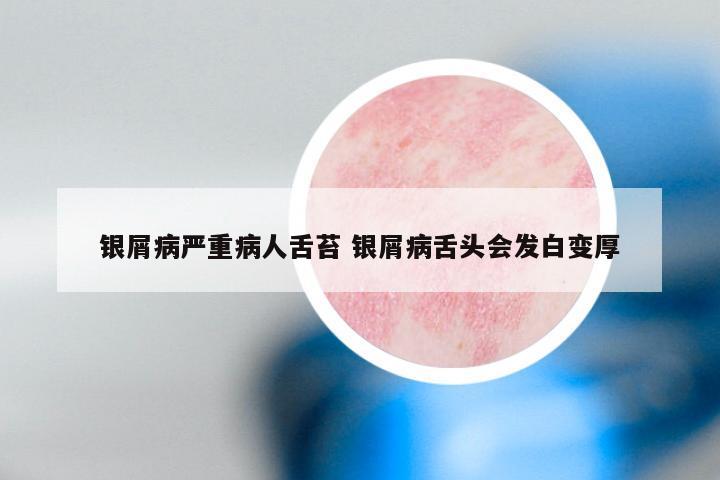 银屑病严重病人舌苔 银屑病舌头会发白变厚