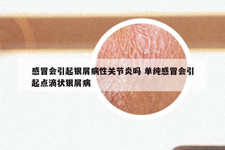 感冒会引起银屑病性关节炎吗 单纯感冒会引起点滴状银屑病