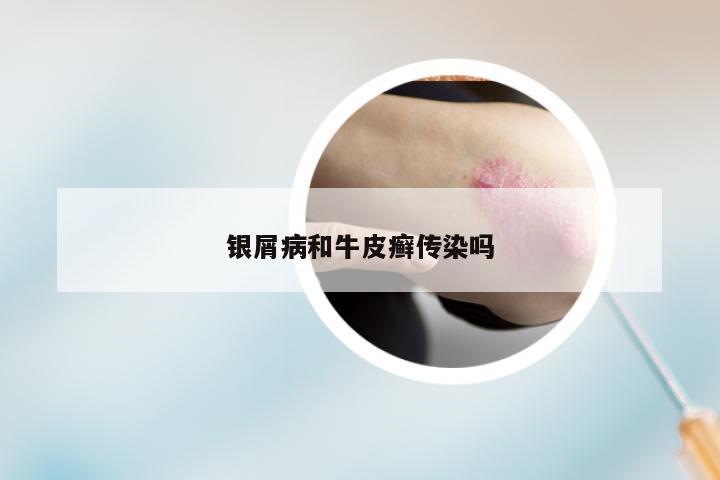 银屑病和牛皮癣传染吗