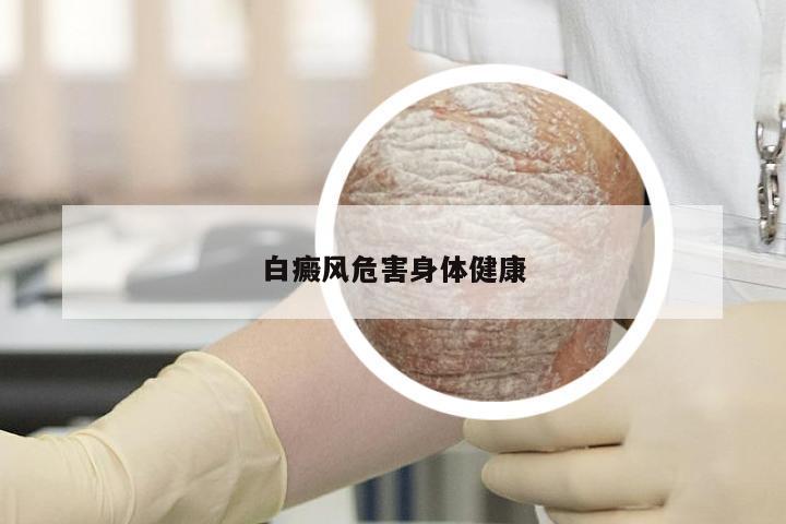 白癜风危害身体健康