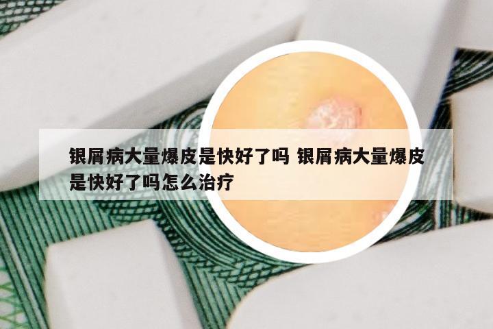 银屑病大量爆皮是快好了吗 银屑病大量爆皮是快好了吗怎么治疗