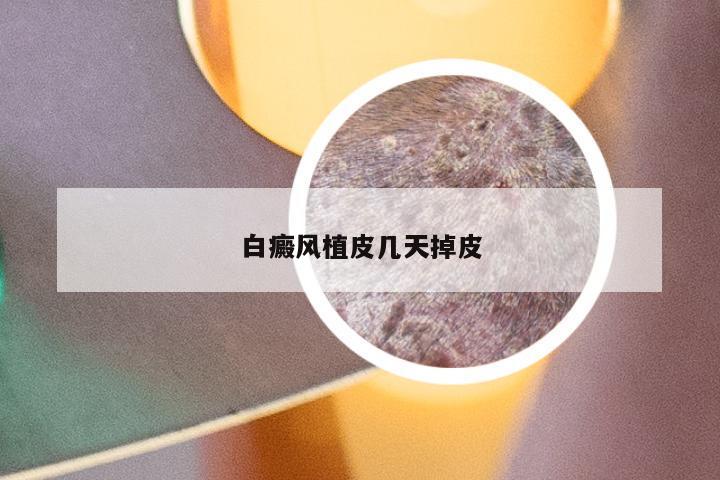 白癜风植皮几天掉皮