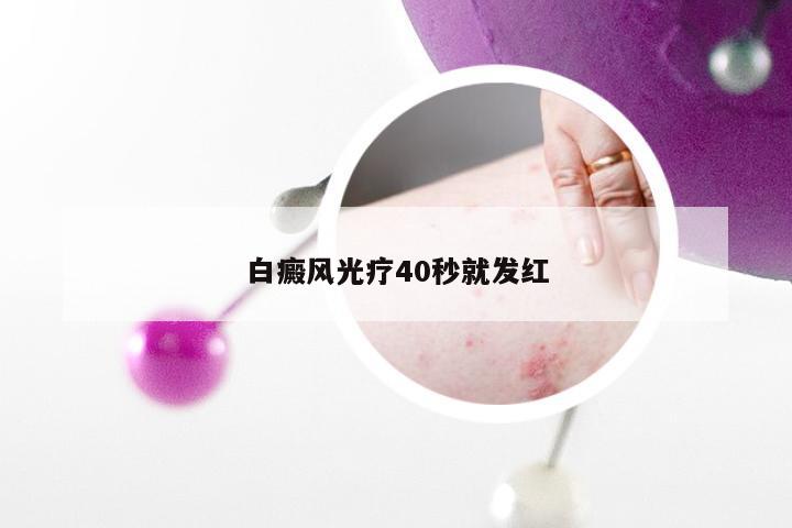 白癜风光疗40秒就发红