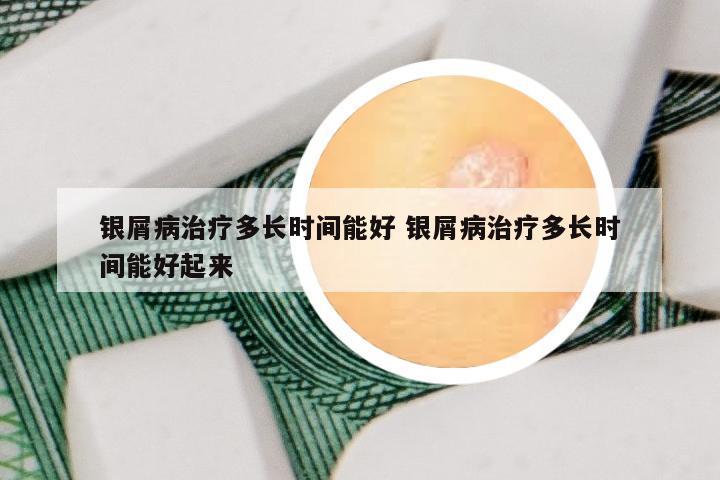 银屑病治疗多长时间能好 银屑病治疗多长时间能好起来