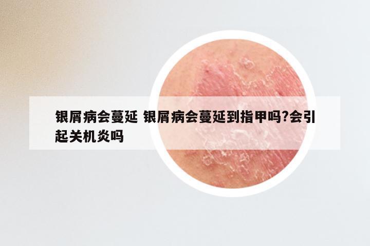 银屑病会蔓延 银屑病会蔓延到指甲吗?会引起关机炎吗