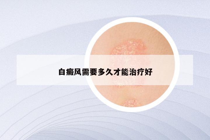 白癜风需要多久才能治疗好