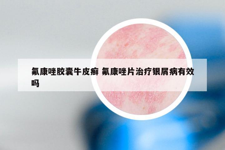 氟康唑胶囊牛皮癣 氟康唑片治疗银屑病有效吗