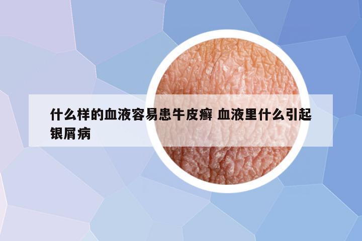 什么样的血液容易患牛皮癣 血液里什么引起银屑病