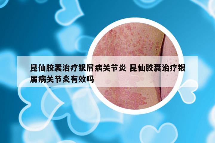 昆仙胶囊治疗银屑病关节炎 昆仙胶囊治疗银屑病关节炎有效吗