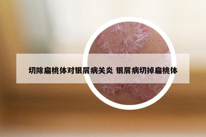 切除扁桃体对银屑病关炎 银屑病切掉扁桃体