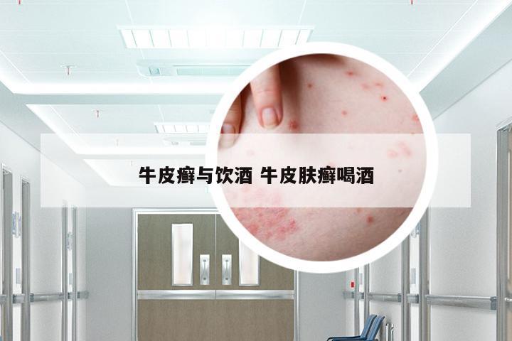 牛皮癣与饮酒 牛皮肤癣喝酒