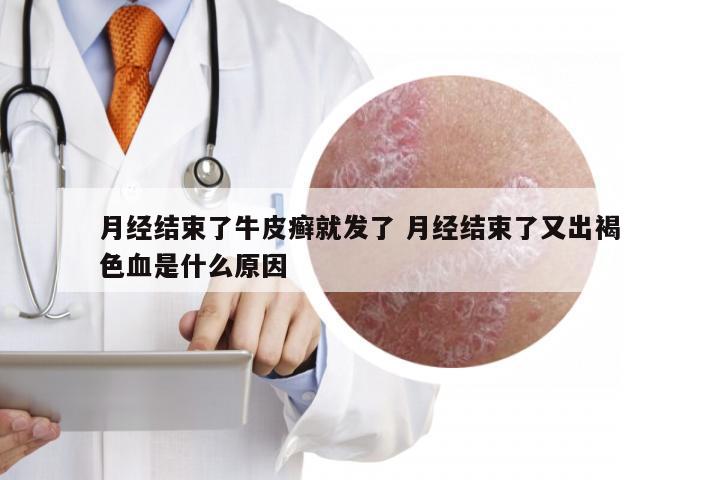 月经结束了牛皮癣就发了 月经结束了又出褐色血是什么原因