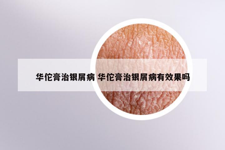 华佗膏治银屑病 华佗膏治银屑病有效果吗
