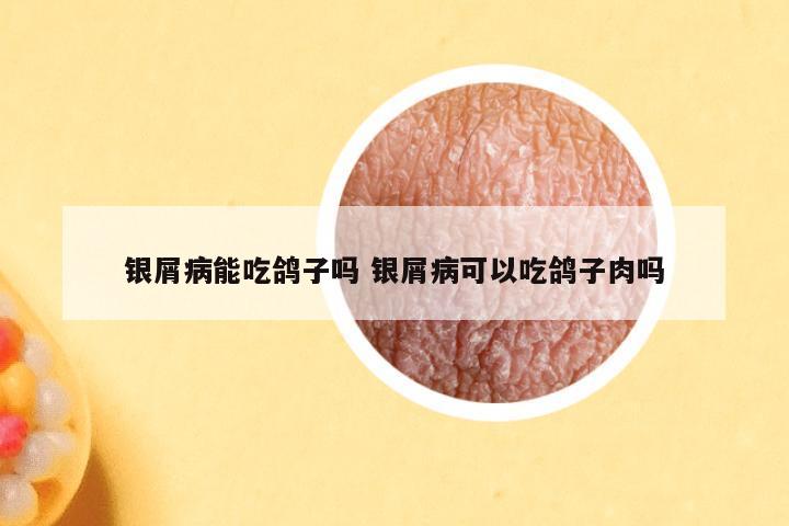 银屑病能吃鸽子吗 银屑病可以吃鸽子肉吗