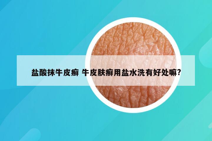 盐酸抹牛皮癣 牛皮肤癣用盐水洗有好处嘛?