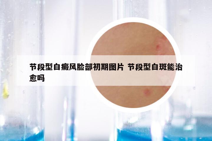 节段型白癜风脸部初期图片 节段型白斑能治愈吗