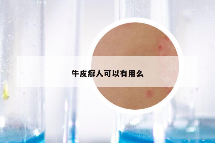 牛皮癣人可以有用么