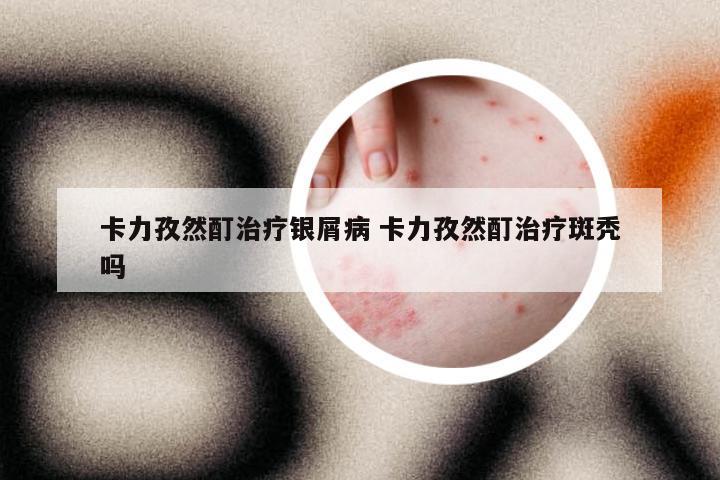 卡力孜然酊治疗银屑病 卡力孜然酊治疗斑秃吗