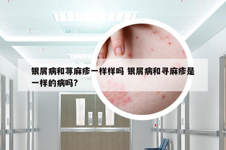 银屑病和荨麻疹一样样吗 银屑病和寻麻疹是一样的病吗?