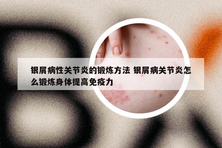 银屑病性关节炎的锻炼方法 银屑病关节炎怎么锻炼身体提高免疫力