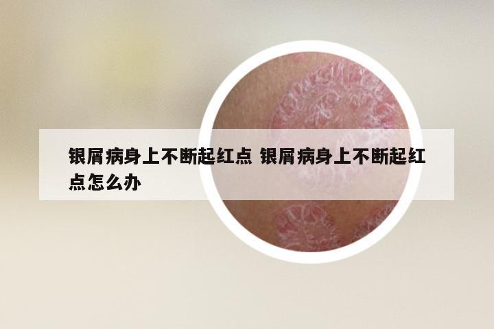 银屑病身上不断起红点 银屑病身上不断起红点怎么办