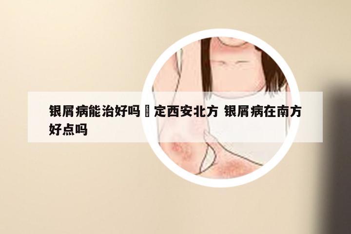 银屑病能治好吗約定西安北方 银屑病在南方好点吗