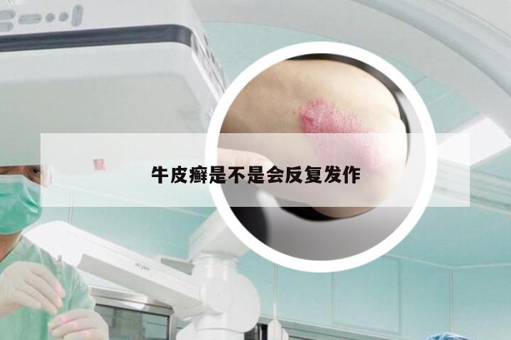牛皮癣是不是会反复发作