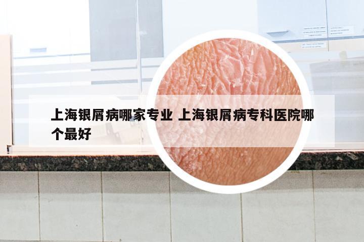 上海银屑病哪家专业 上海银屑病专科医院哪个最好
