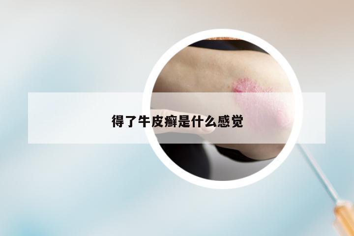 得了牛皮癣是什么感觉