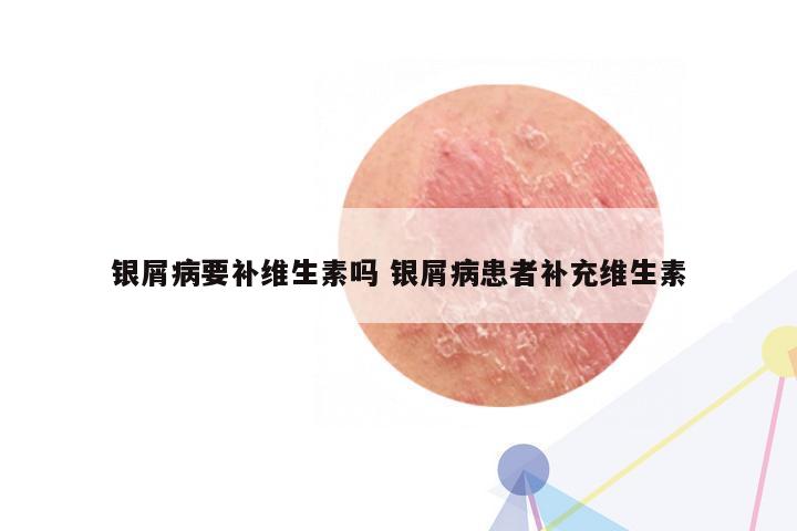 银屑病要补维生素吗 银屑病患者补充维生素