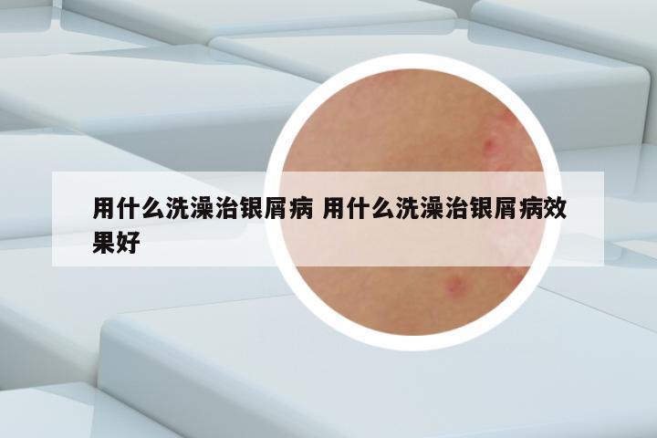 用什么洗澡治银屑病 用什么洗澡治银屑病效果好