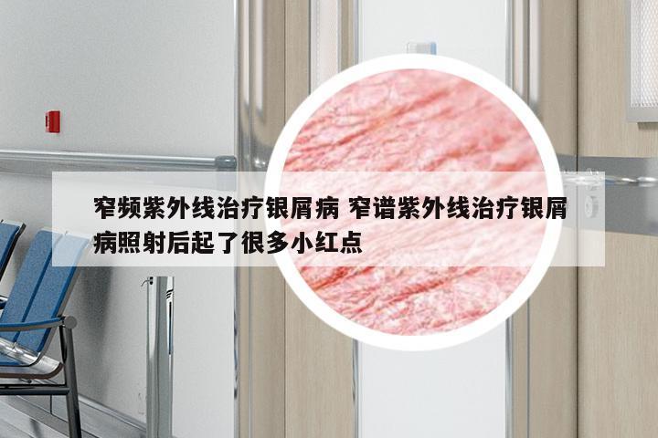 窄频紫外线治疗银屑病 窄谱紫外线治疗银屑病照射后起了很多小红点