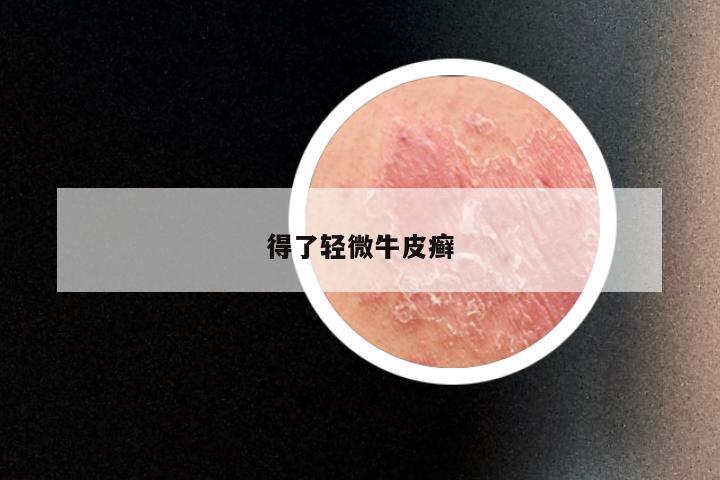 得了轻微牛皮癣