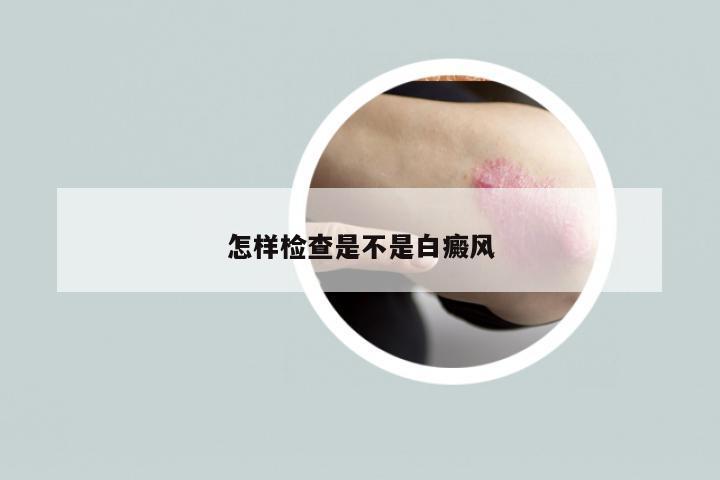怎样检查是不是白癜风