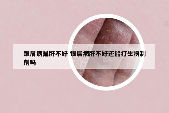 银屑病是肝不好 银屑病肝不好还能打生物制剂吗