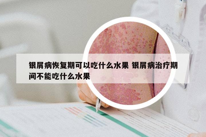 银屑病恢复期可以吃什么水果 银屑病治疗期间不能吃什么水果