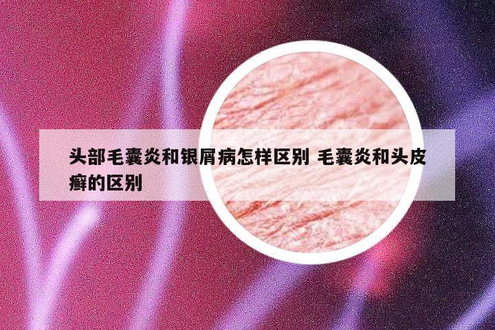 头部毛囊炎和银屑病怎样区别 毛囊炎和头皮癣的区别