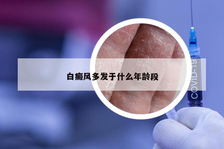 白癜风多发于什么年龄段