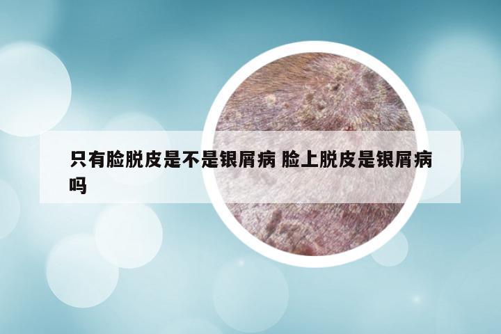 只有脸脱皮是不是银屑病 脸上脱皮是银屑病吗