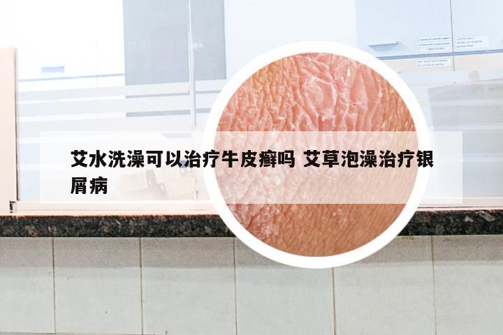 艾水洗澡可以治疗牛皮癣吗 艾草泡澡治疗银屑病